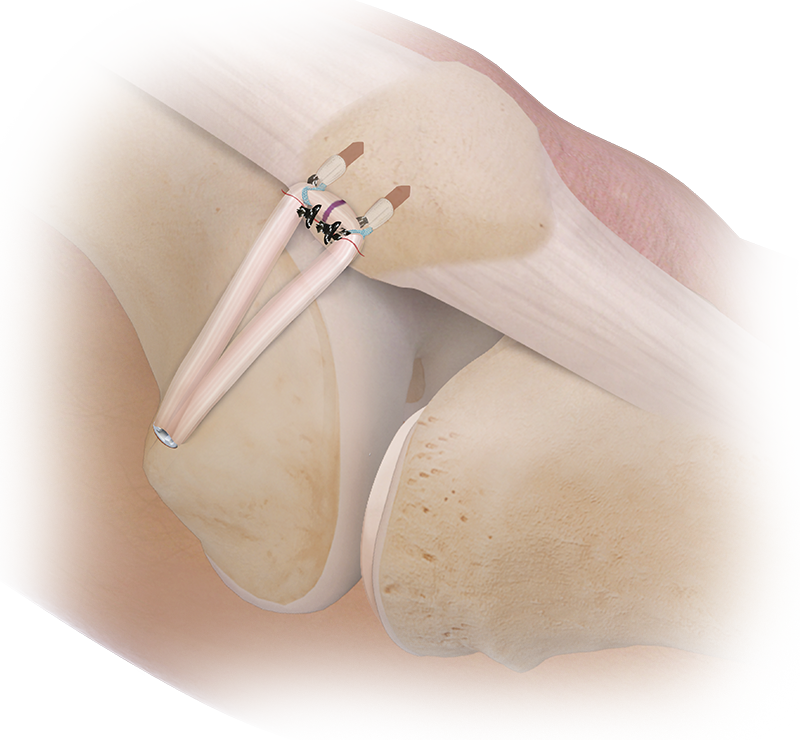 Arthrex - All-Epiphyseal, All-Onlay MPFL Reconstruction